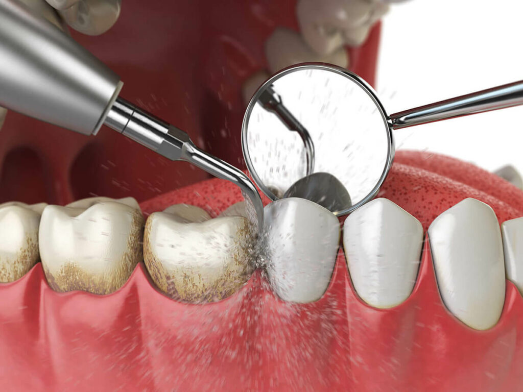 illustration of professional teeth cleaning removing plaque build up