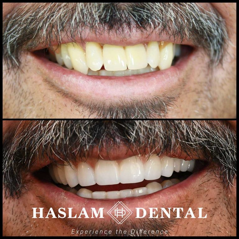 before and after photos of teeth with all on 4 dental implants by haslam dental, a dentist office in ogden utah