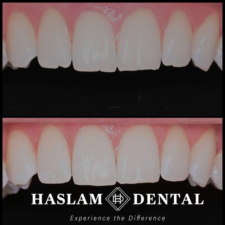 before and after photos of teeth with dental bonding applied by haslam dental, a dentist office in ogden utah