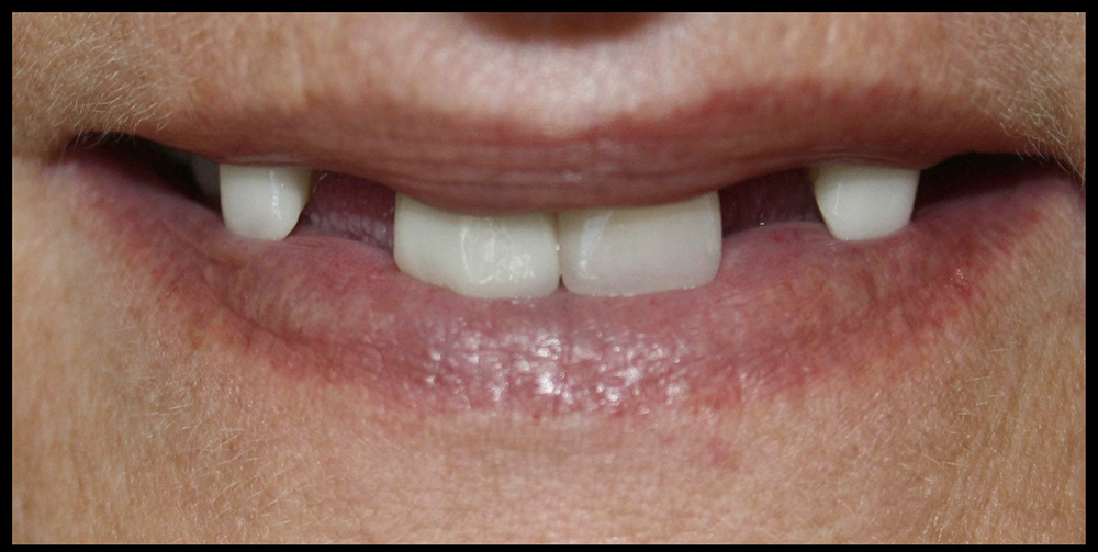 smile before all on 4 dental implants