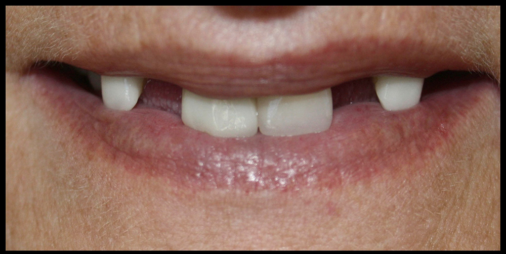 The image shows a close-up view of a person's mouth. Two upper front teeth are missing, leaving visible gaps, while the surrounding teeth appear healthy. The lips have a dry texture, emphasizing the dental gaps and possibly indicating the need for dental care or prosthetic solutions.