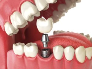 Illustration of a dental implant being placed into a row of teeth