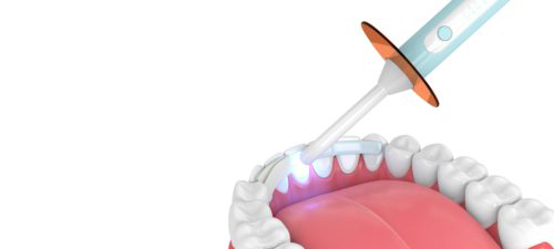 illustration of dental bonding being applied to the bottom row of teeth