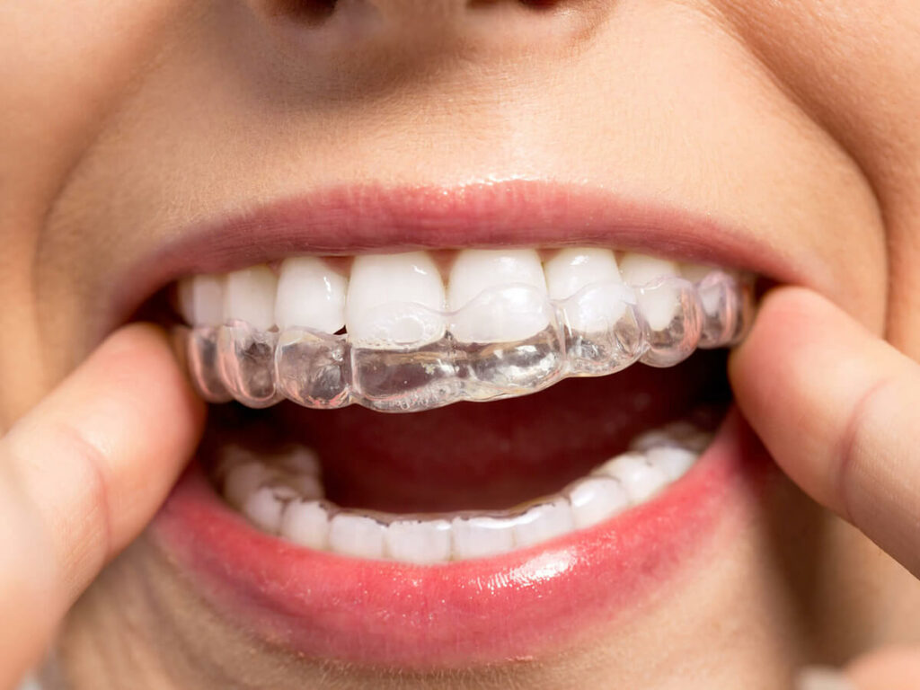 Close-up of a person adjusting clear aligners on their upper teeth, showcasing their use for dental correction.