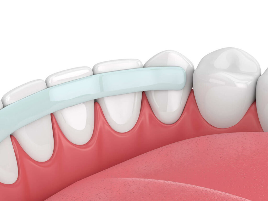 illustration of dental bonding applied to bottom row of teeth