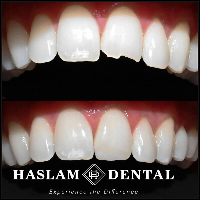 before and after photos of teeth with dental bonding applied by haslam dental, a dentist office in ogden utah