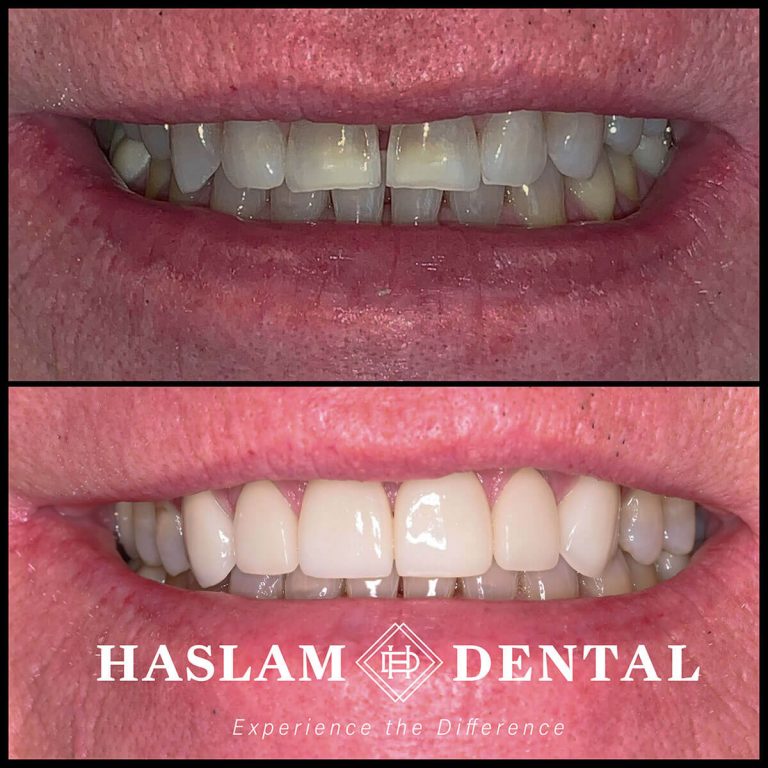 before and after photos of teeth with dental veneers from haslam dental, a dentist office in ogden utah