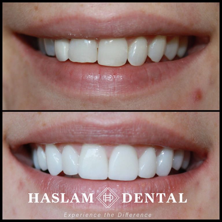 before and after photos of teeth with dental veneers from haslam dental, a dentist office in ogden utah