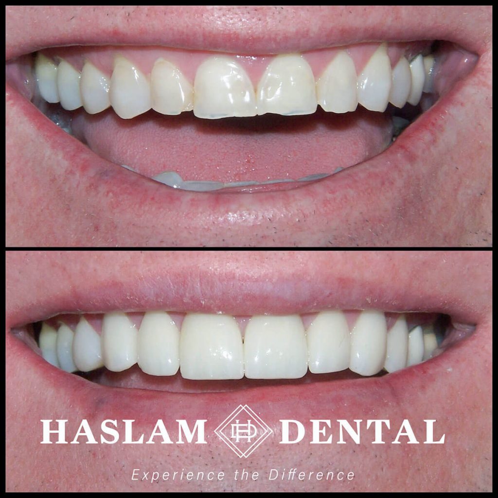 before and after photos of teeth with dental veneers from haslam dental, a dentist office in ogden utah