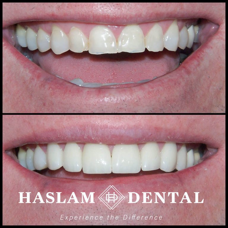 before and after photos of teeth with dental veneers from haslam dental, a dentist office in ogden utah