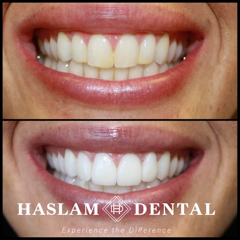 before and after photos of teeth with dental veneers from haslam dental, a dentist office in ogden utah