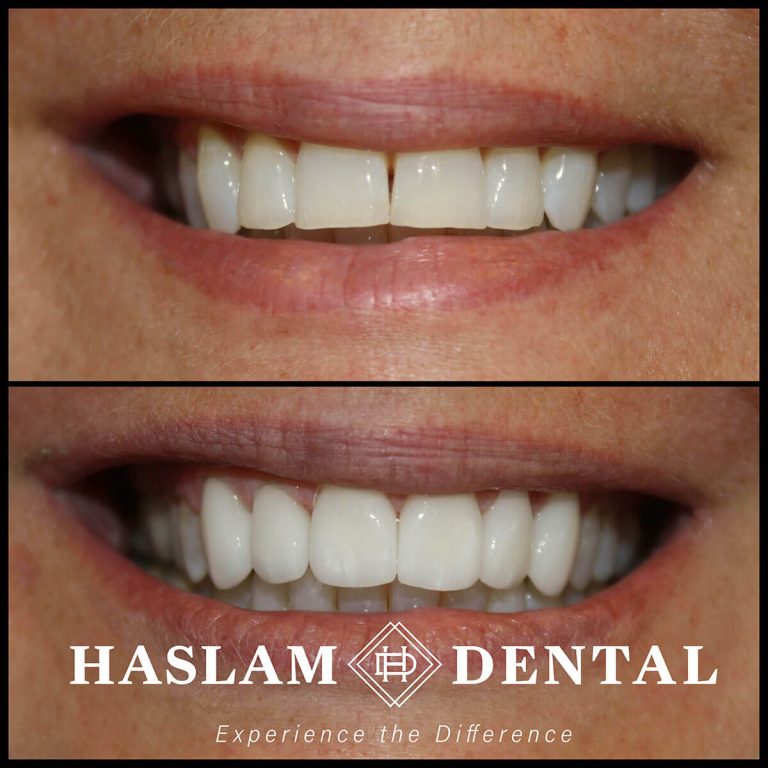 before and after photos of teeth with dental veneers from haslam dental, a dentist office in ogden utah