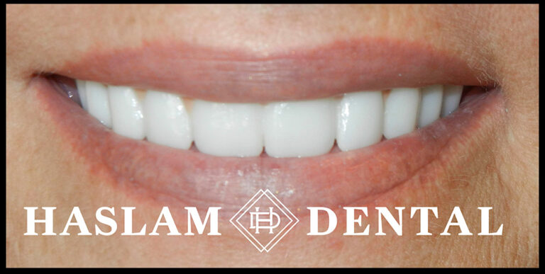 smile after all on 4 dental implants