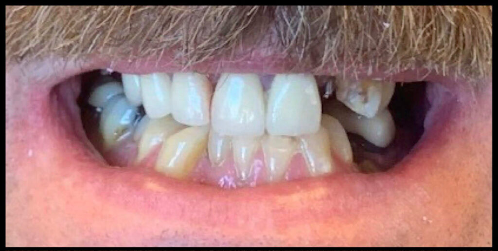 top teeth before all on 4 dental implants