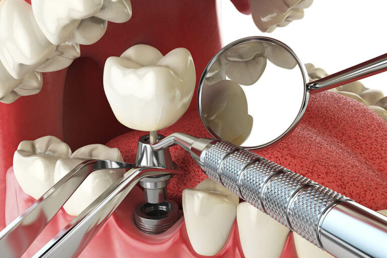 dental implant with dental tools