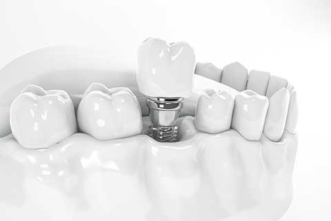 Close-up image showing a dental implant next to adjacent teeth. The implant features a metal post anchored into the jawbone, with its crown seamlessly aligned, showcasing its integration into the oral cavity.